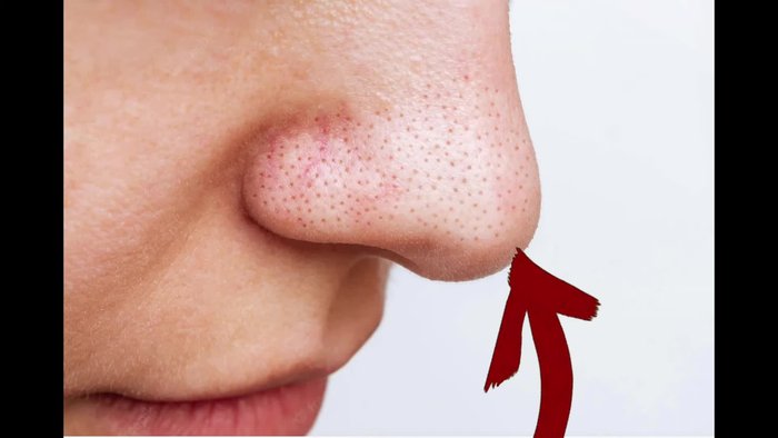 Apply SPF after using a chemical exfoliant to protect your skin from sun damage.